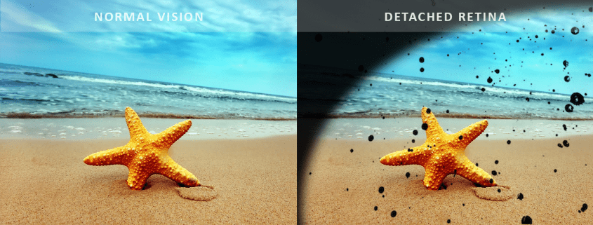 Advanced retina surgery at Best Eye Hospital in Bathinda | Vasu Eye Institute & Skin Centre