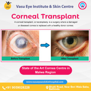 cornea clinic at Best Eye Hospital in Bathinda