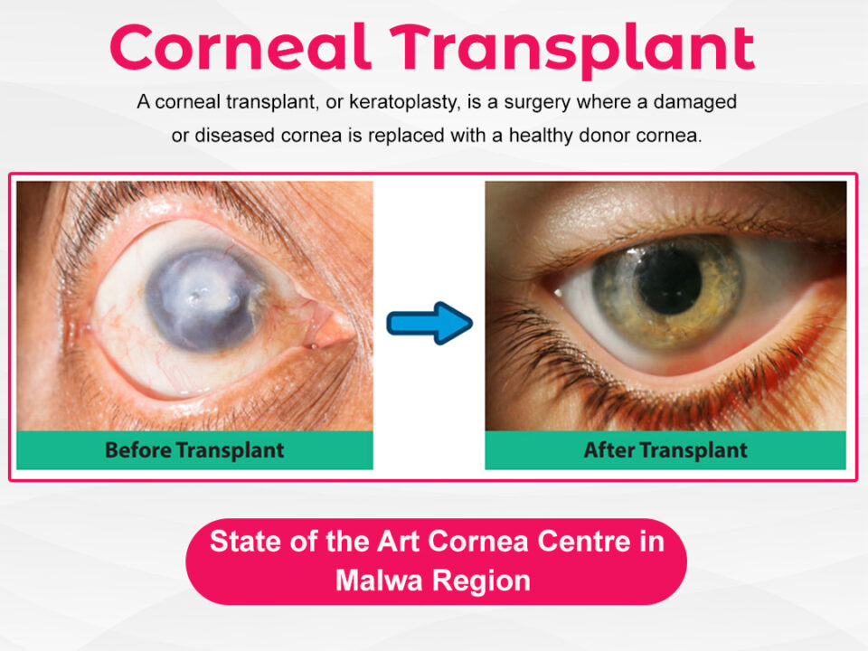 cornea clinic at Best Eye Hospital in Bathinda