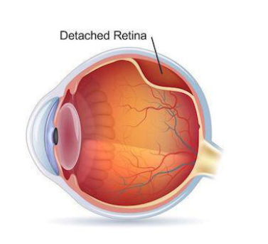 Retinal Detachment Treatment in Bathina