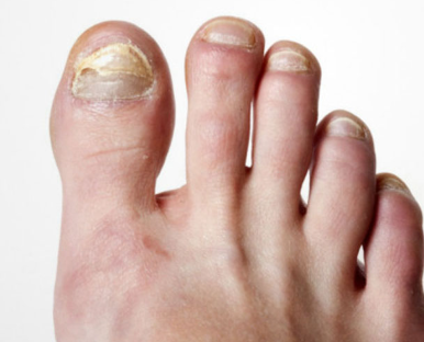 Nail Diseases Treatment