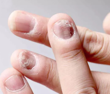 Nail Diseases Treatment