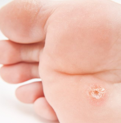Wart Removal