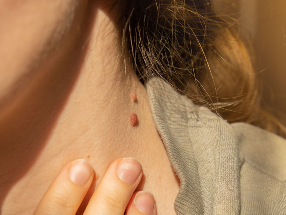 Warts Skin tags removal Bathinda