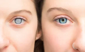 Glaucoma Treatment in Bathinda