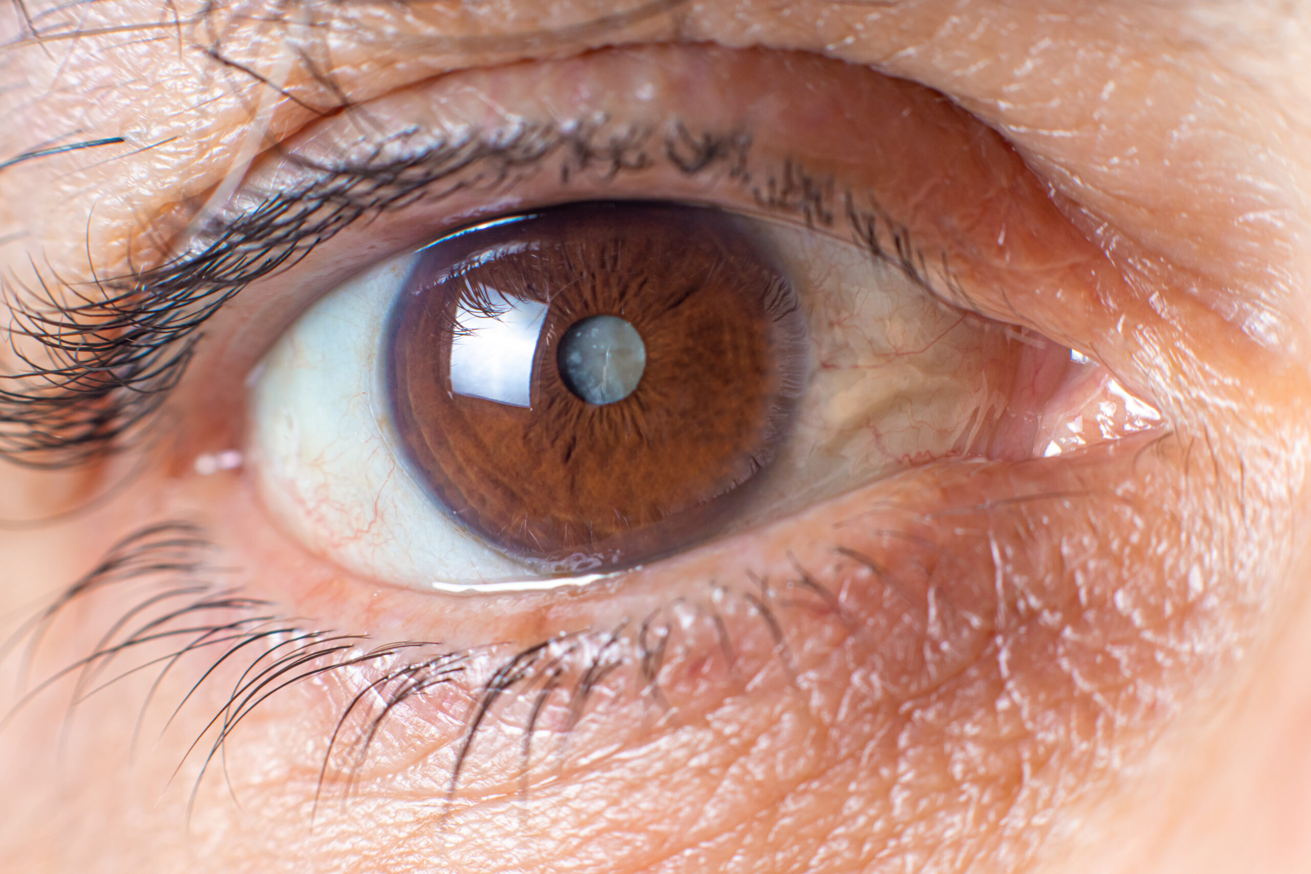 Sign and Symptoms of Cataract Eye: Guide for Early Detection
