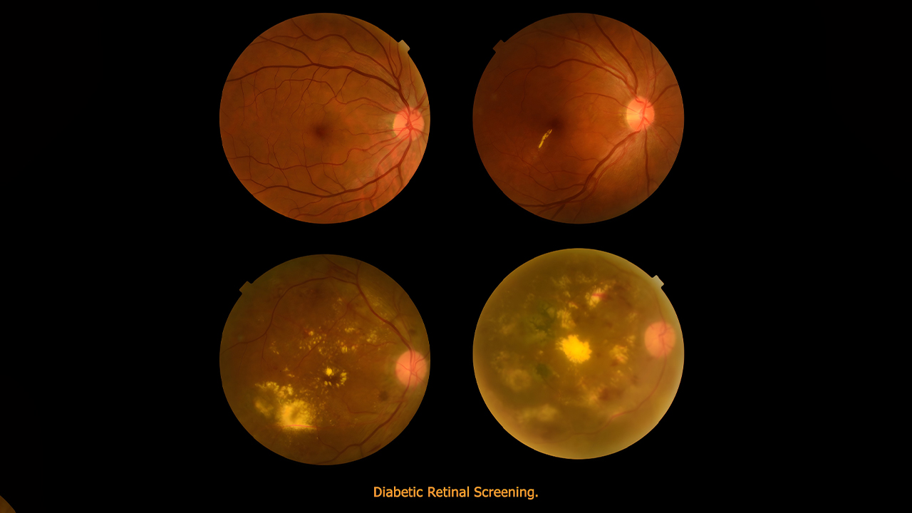 Retina Screening Helps Diabetic Patients